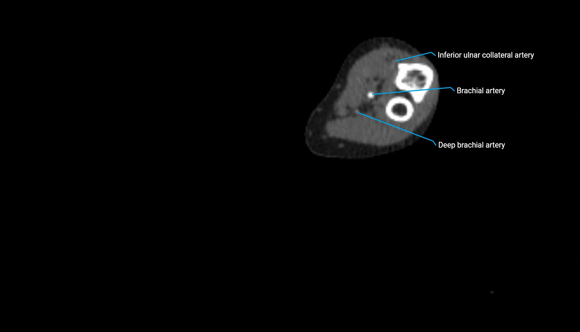 CTA upper limb axial cross sectional anatomy labelled image 177 (2).webp